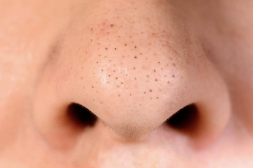 What are Blackheads and How To Treat Them? - My Cozy Room