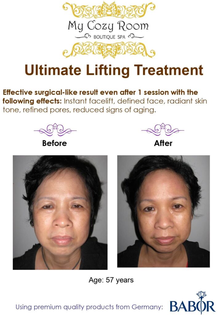 Wrinkle Facial Treatment Before After