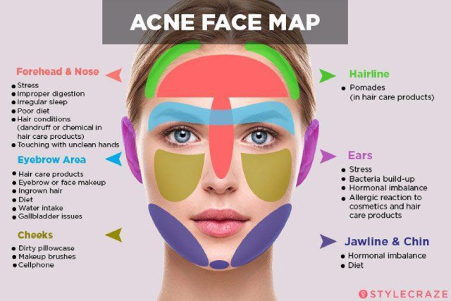 Understanding Your Skin: Where Your Acne Appears Matters