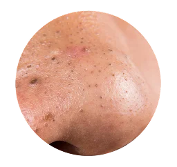 Blackheads