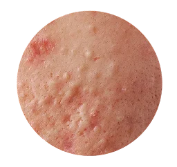 Pimples