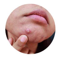 Pustules