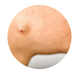 Nodules