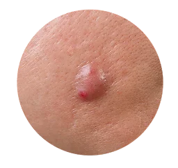 Cysts