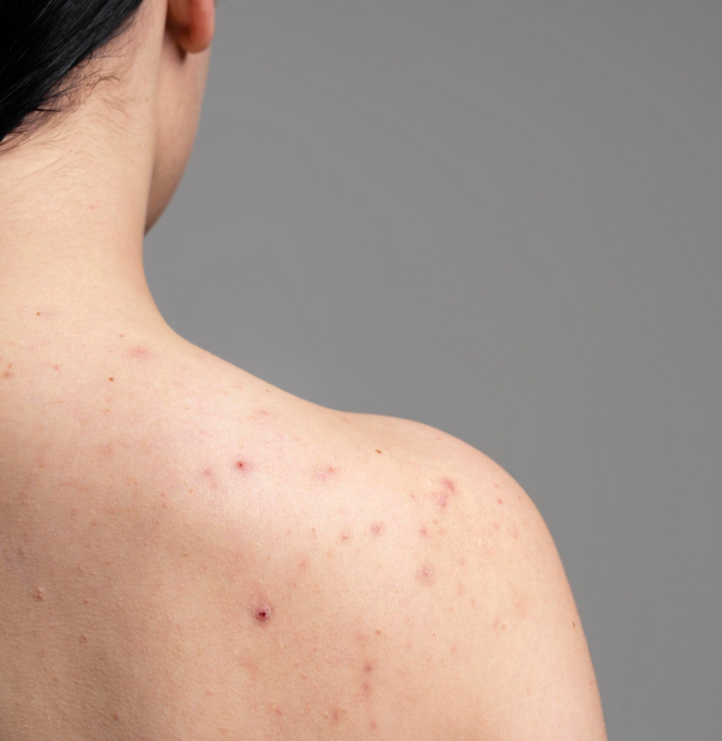 Back Acne