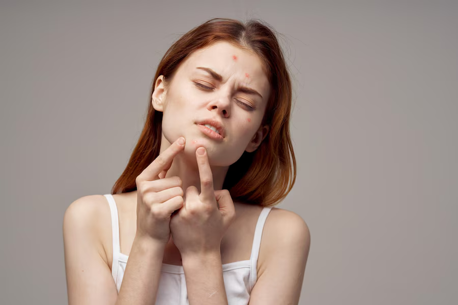 Stress/Hormonal Acne