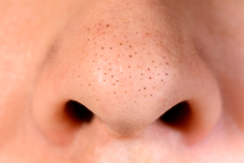 Whiteheads and Blackheads