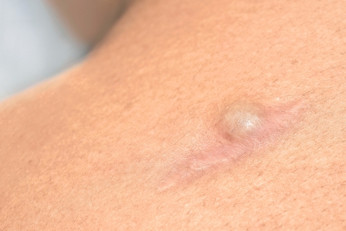 Cysts