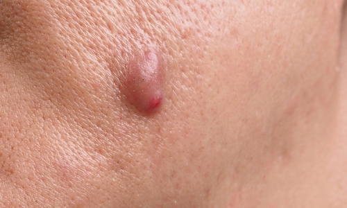 Nodules