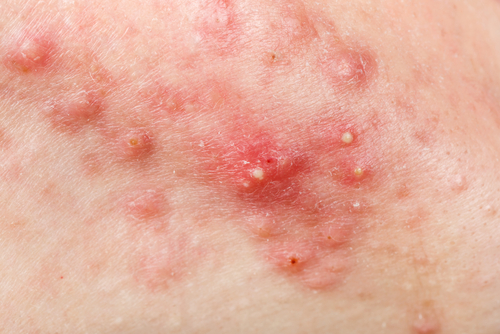 Papules and Pustules