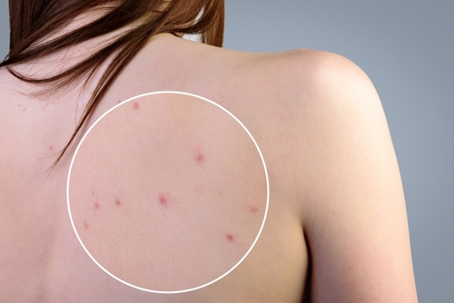 Pimples
