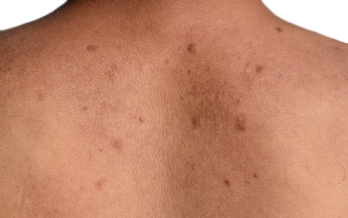 Blackheads