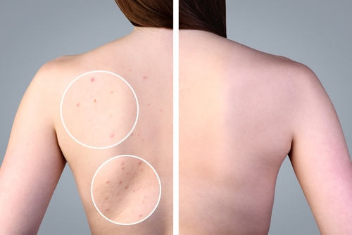 Excess oil (sebum) production