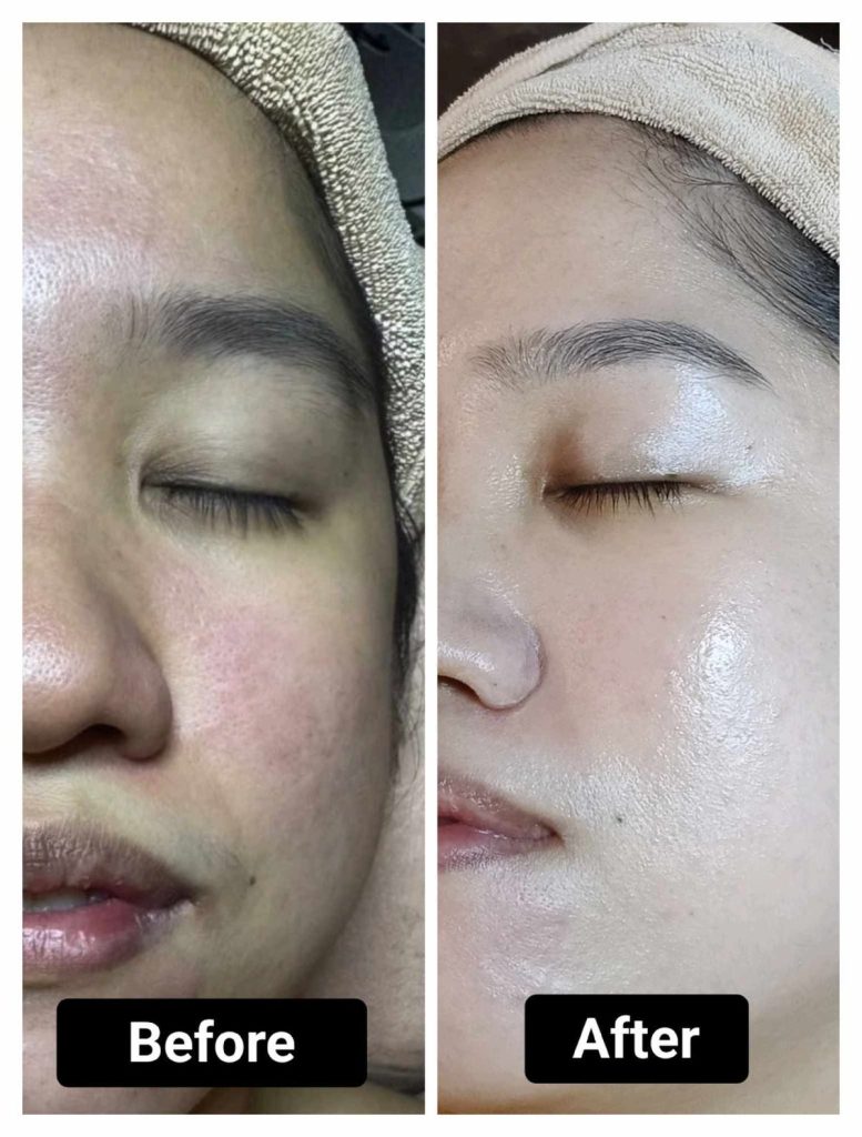 BeKind Pro Anti-Aging Facial Treatment results