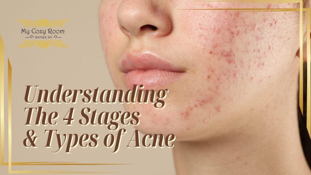 Understanding the Stages & Types of Acne: How Facials Can Help You Heal Breakouts Gently and Effectively