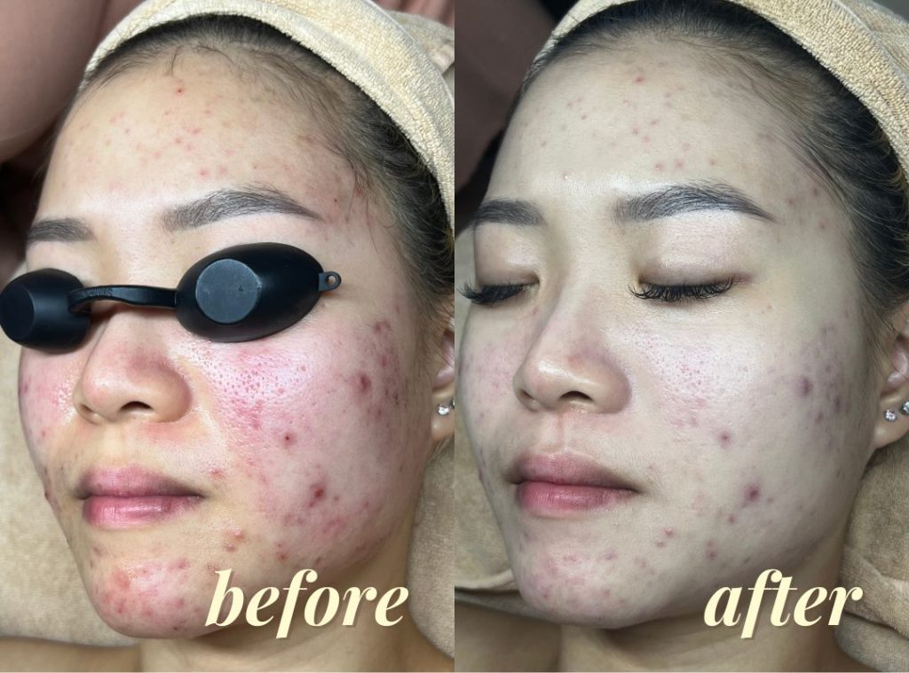The Results: Clearer Skin With Fewer Blemishes