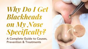 Why Do I Get Blackheads on My Nose Specifically? A Complete Guide to Causes, Prevention & Treatments