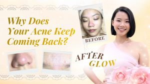 Why Does Your Acne Keep Coming Back?