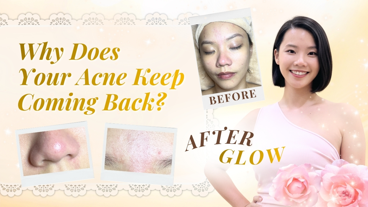 Why Does Your Acne Keep Coming Back?