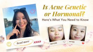Is Acne Genetic or Hormonal? Here’s What You Need to Know