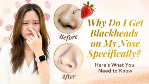 Why Do I Get Blackheads on My Nose Specifically? Here’s What You Need to Know