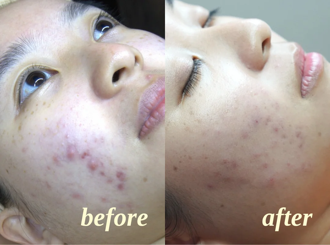 Before and after a recommended facial in Singapore: red acne spots on a client's cheek, then fewer, paler spots