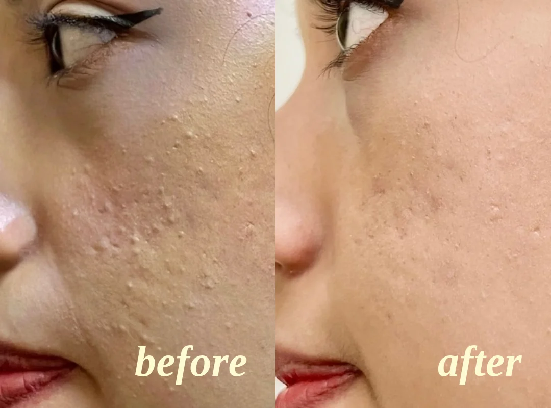Before and after a Singapore facial: small bumps across a client's cheek, then visibly smoother skin
