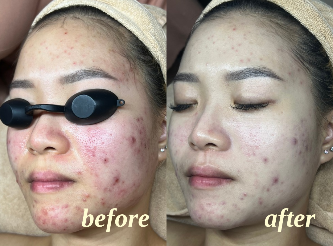 Client facial results, before on the left and after on the right, comparison 1