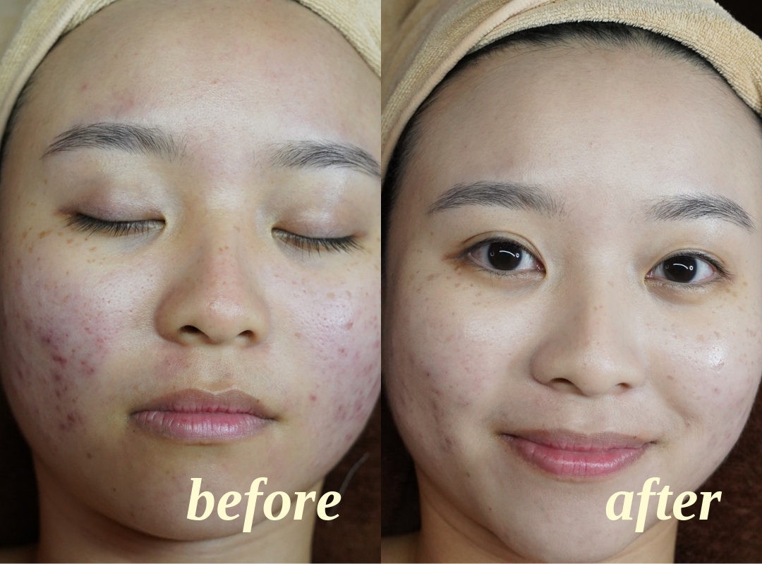 Client facial results, before on the left and after on the right, comparison 2
