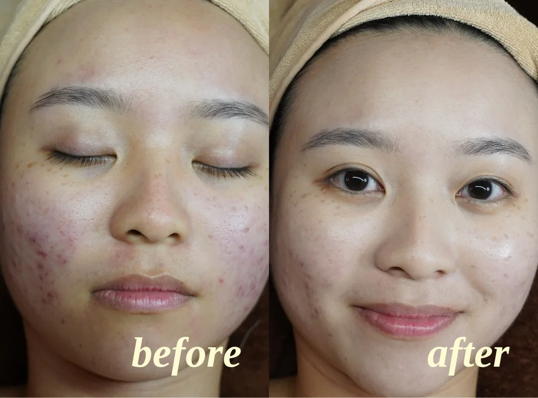 Client facial results, before on the left and after on the right, comparison 2