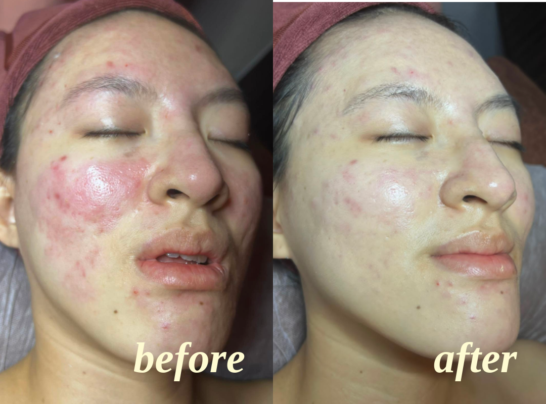 Client facial results, before on the left and after on the right, comparison 5