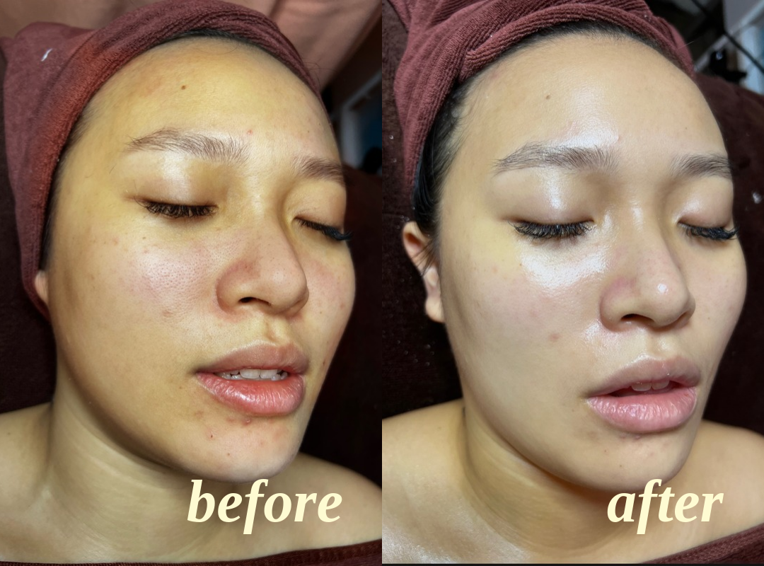 Client facial results, before on the left and after on the right, comparison 6