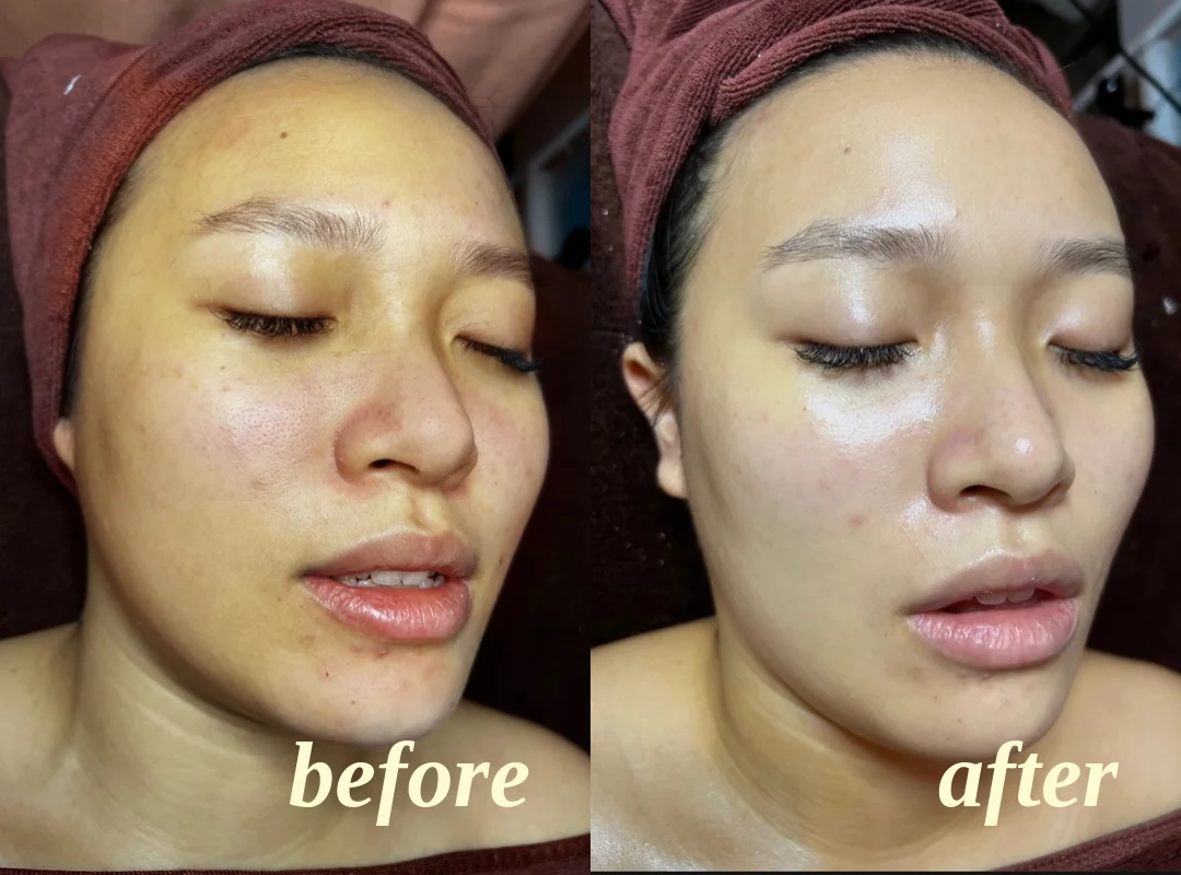 Client facial results, before on the left and after on the right, comparison 6