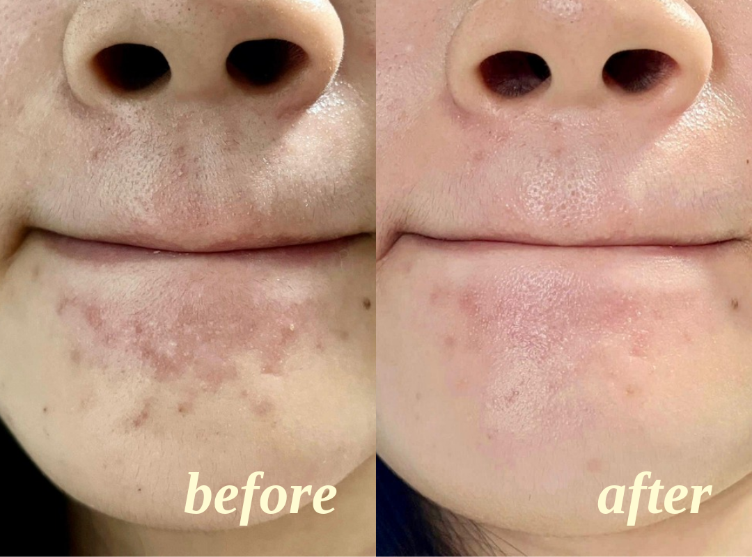 Client facial results, before on the left and after on the right, comparison 7