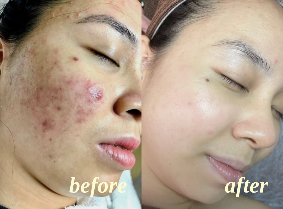 Client facial results, before on the left and after on the right, comparison 8