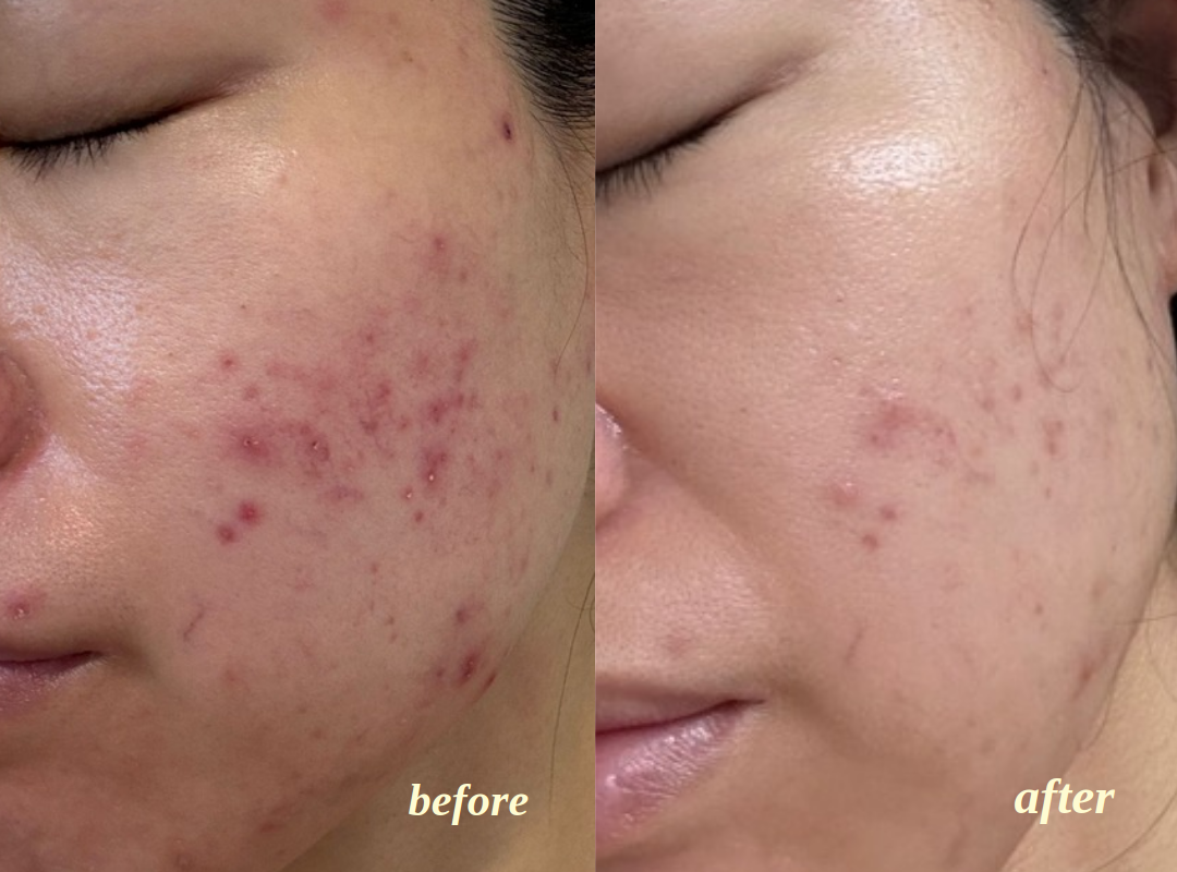 Client facial results, before on the left and after on the right, comparison 9