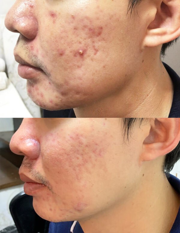 Supplied client before and after facial photographs, comparison 1
