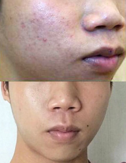 Supplied client before and after facial photographs, comparison 2