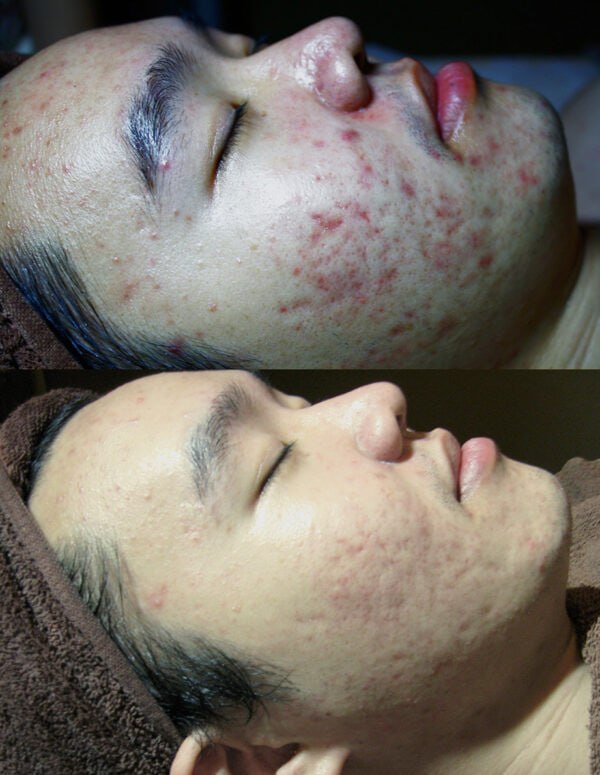 Supplied client before and after facial photographs, comparison 3