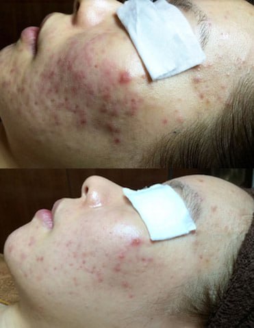 Supplied client before and after facial photographs, comparison 4