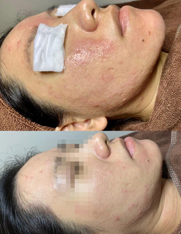 Supplied client before and after facial photographs, comparison 5