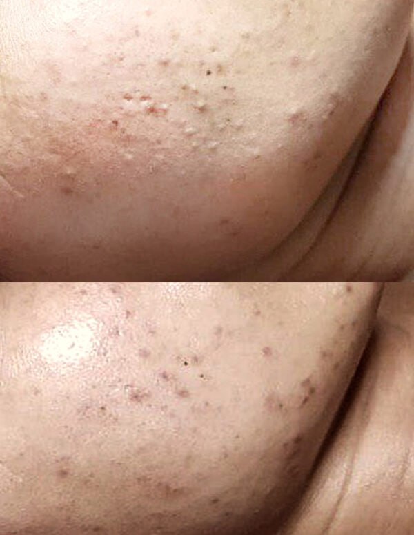 Supplied client before and after facial photographs, comparison 6