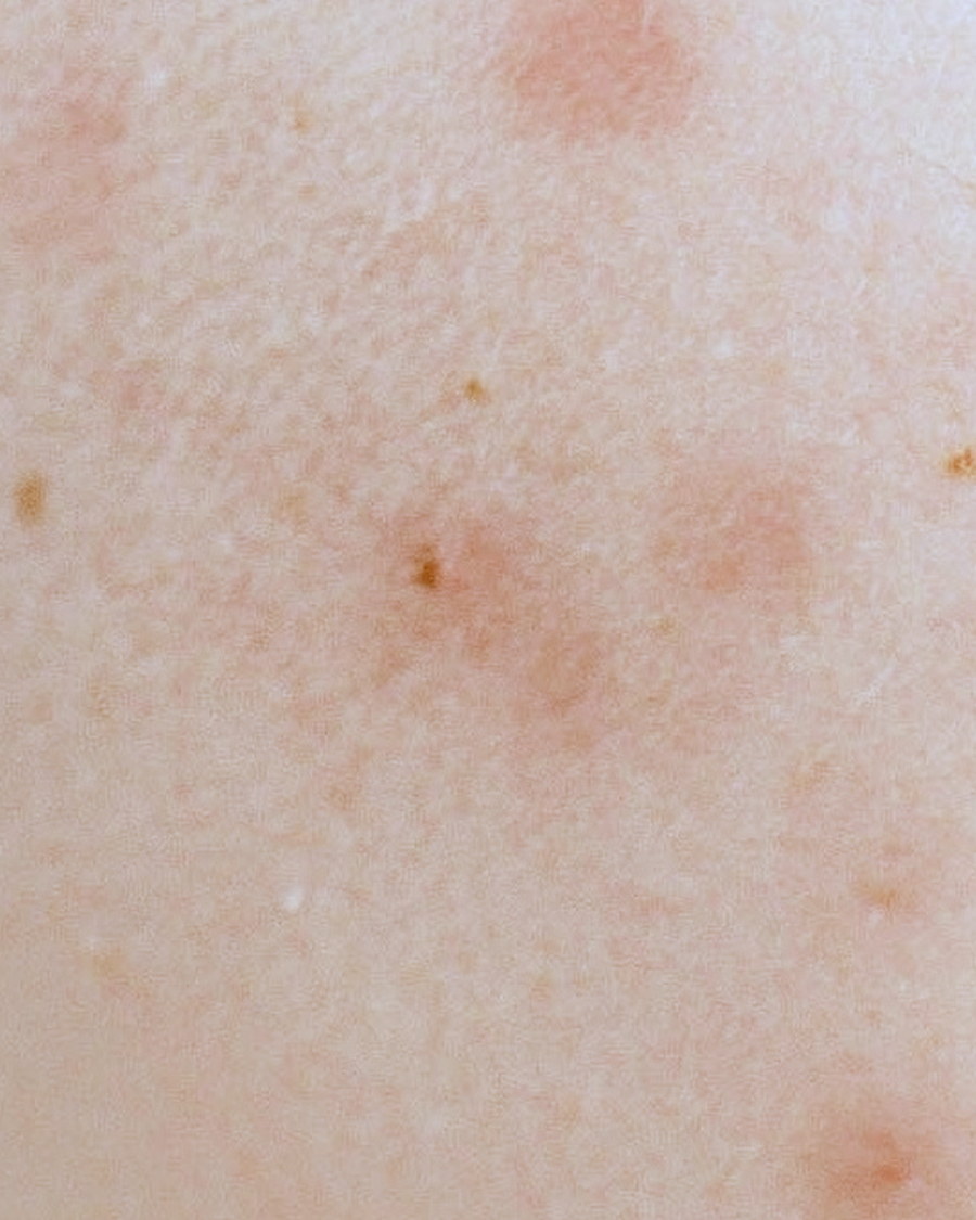 Facial for stress and hormonal acne in Singapore