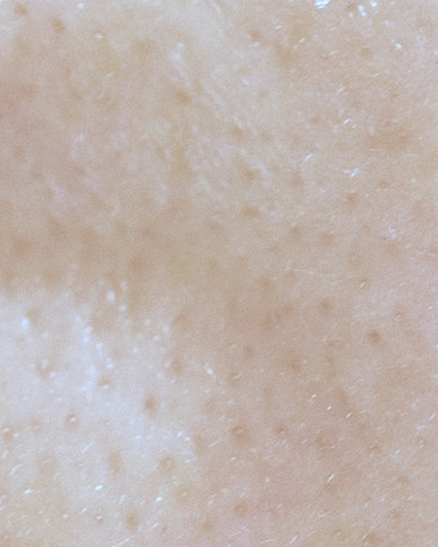 Extraction facial for clogged pores in Singapore