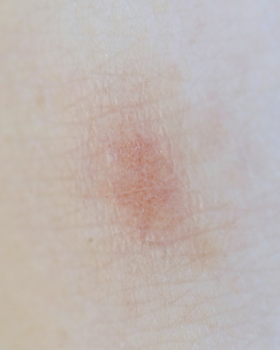 Good facial in Singapore for sensitive skin: close up of a red patch on pale skin